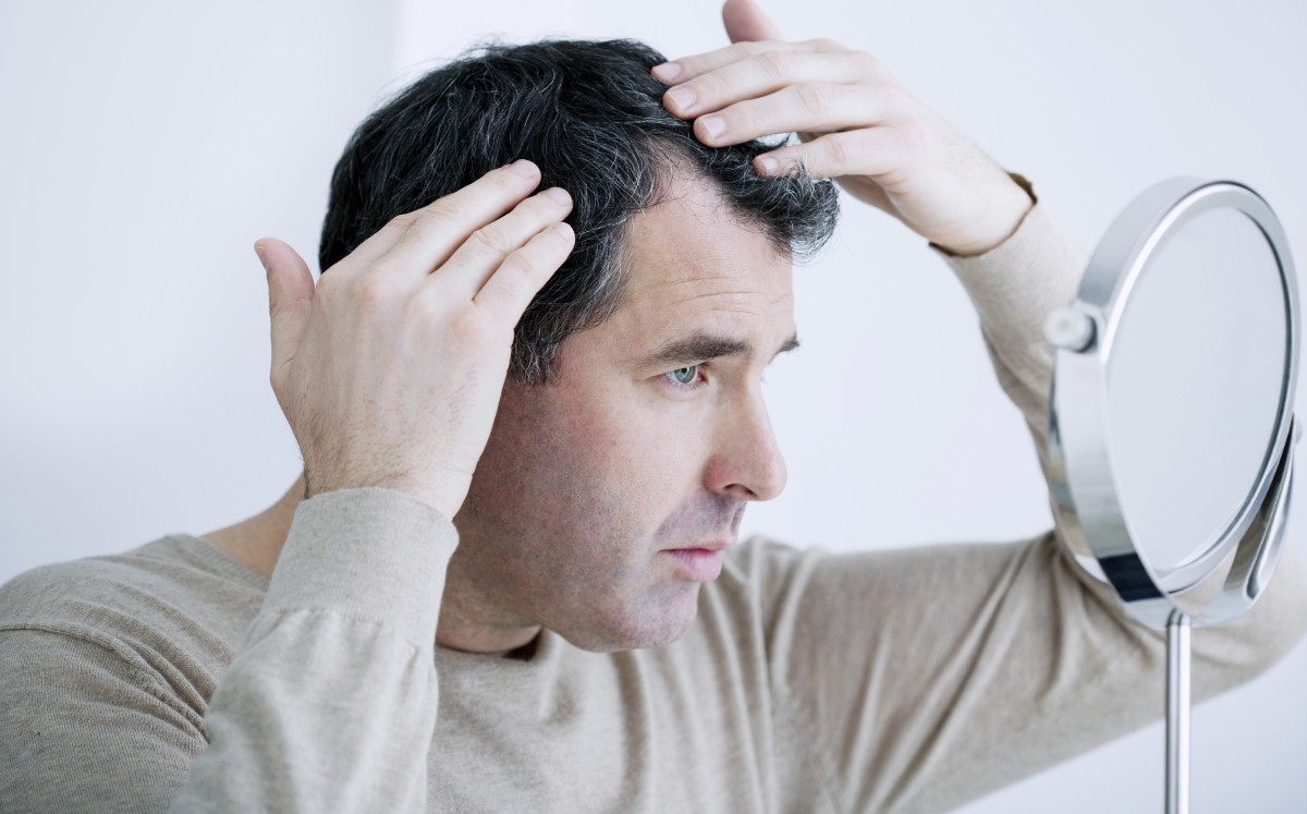 Pérdida de cabello en hombres | Shutterstock
