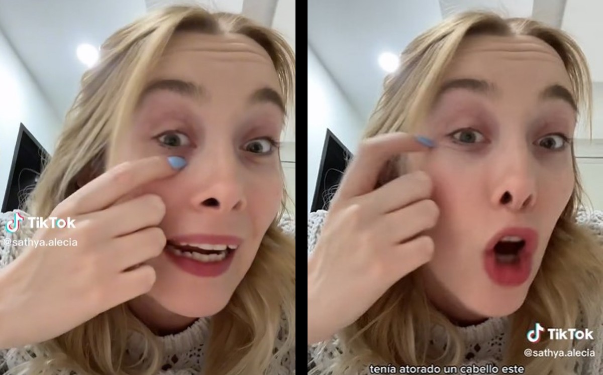 Joven revela que tenía un cabello atorado en el ojo | ESPECIAL