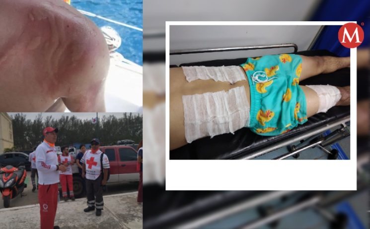 Van 15 quemaduras por agua mala en Playa Miramar