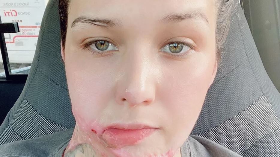 Liliana fue víctima de un violencia química en 2022; acusa que la CEAV le retiró el apoyo