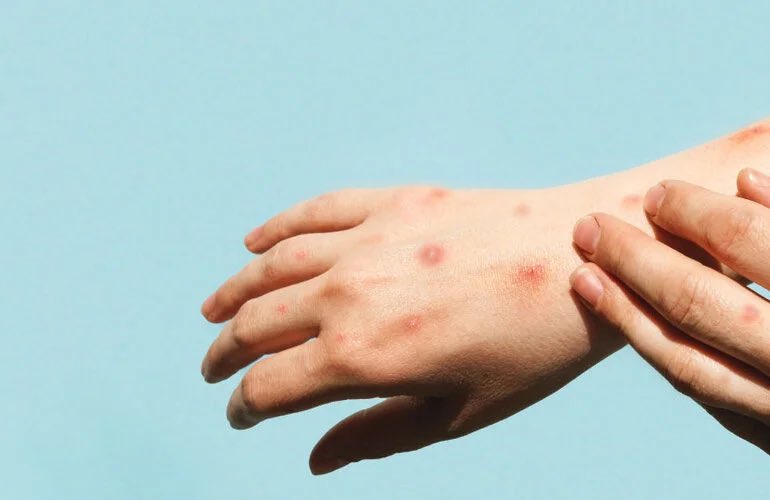 Mpox es una zoonosis causada por el virus de la viruela símica. (Twitter)