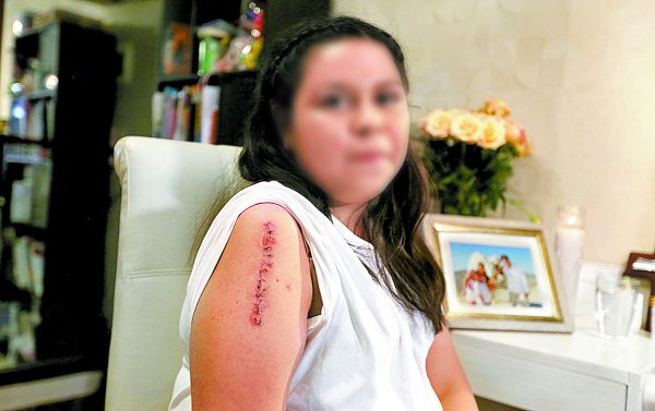 Regina Nolasco muestra la cicatriz en el brazo derecho producto del percance. Javier Ríos