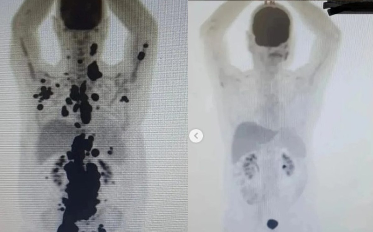 El hombre venció el cáncer tras recibir un tratamiento de células. |  Instagram paulocfperegrino