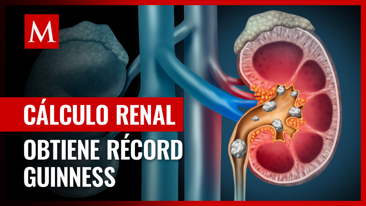 Extirpan el cálculo renal más grande del mundo a paciente en Sri Lanka; obtiene récord guinness