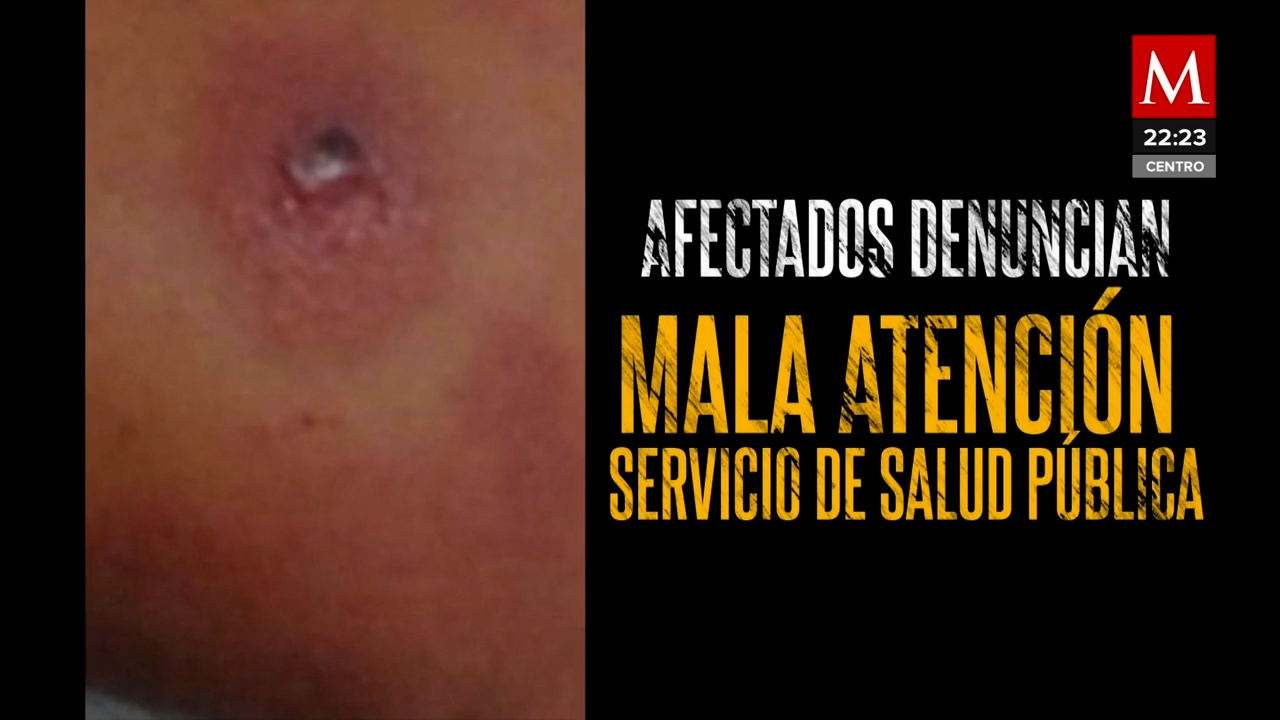 Impacto de la picadura de la "mosca chiclera" en trabajadores del Tren Maya