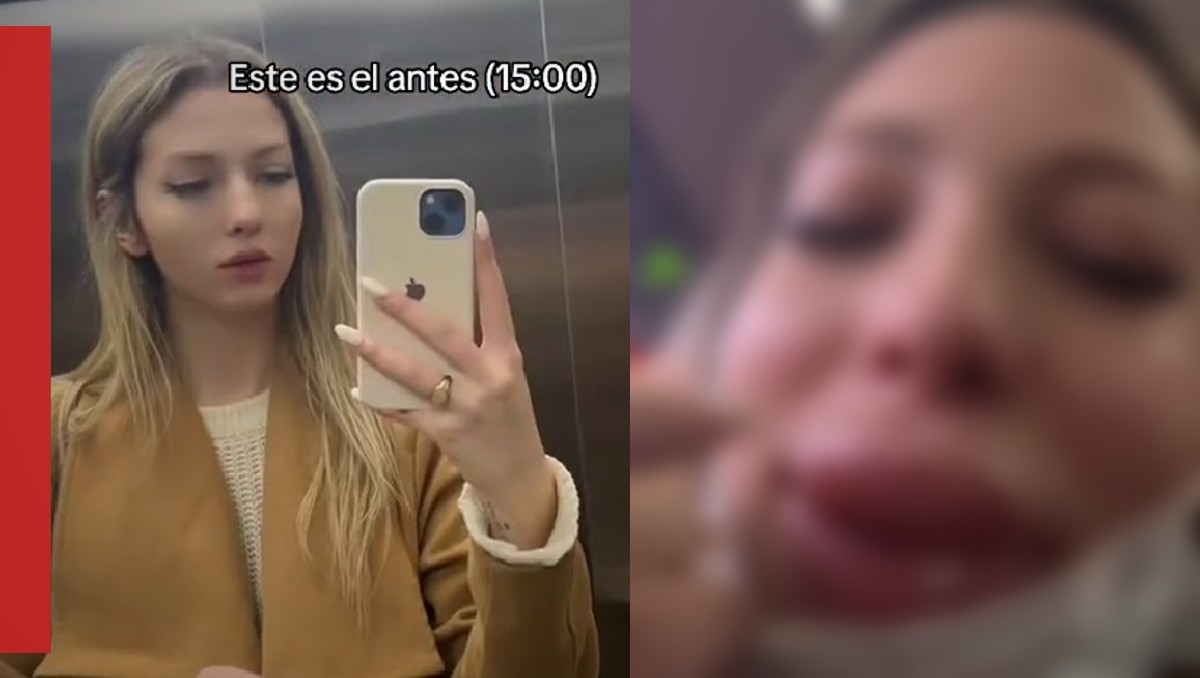 Influencer se somete a cirugía de labios y termina mal | Captura