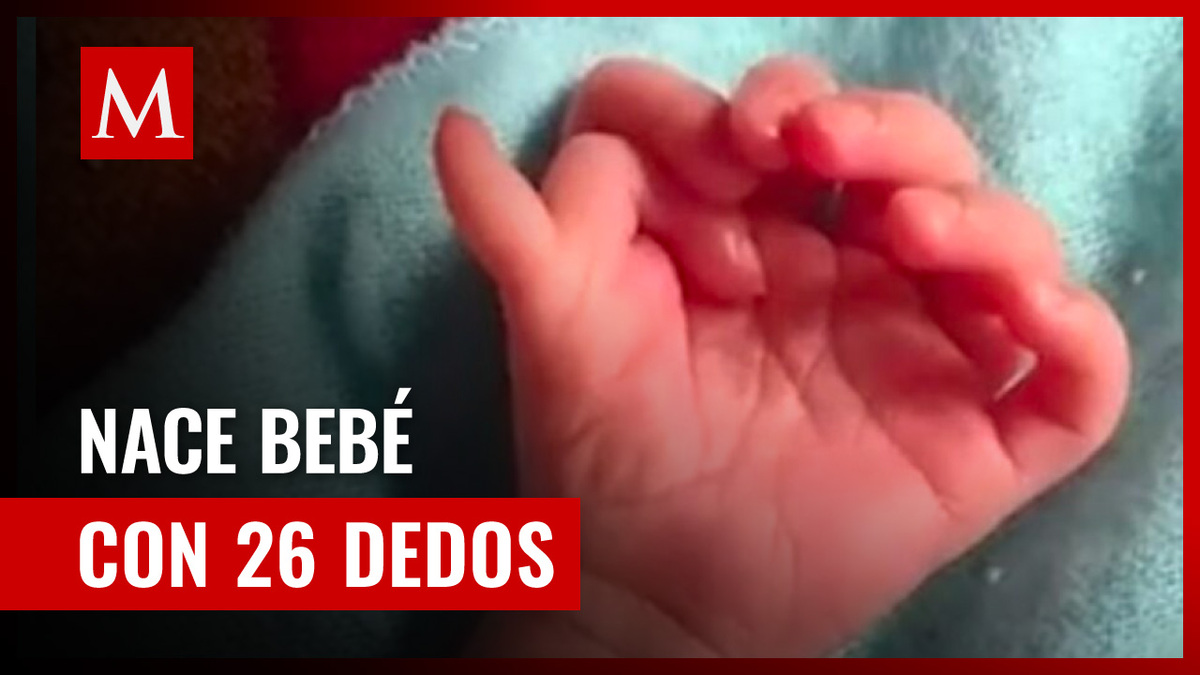 El misterioso caso de la bebé con 26 dedos en Bharatpur, India
