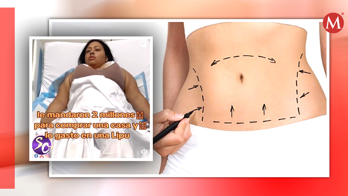 Mujer gastó los ahorros de su esposo en una liposucción. | ESPECIAL