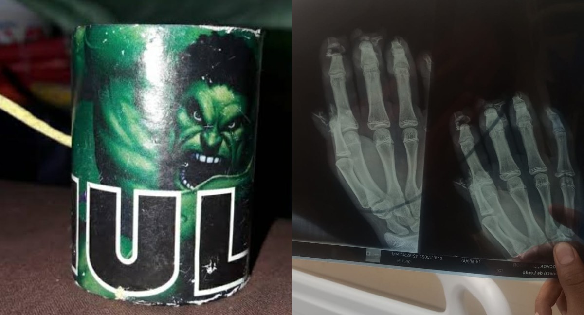 El joven de 14 años estuvo a punto de perder la mano. | Especial