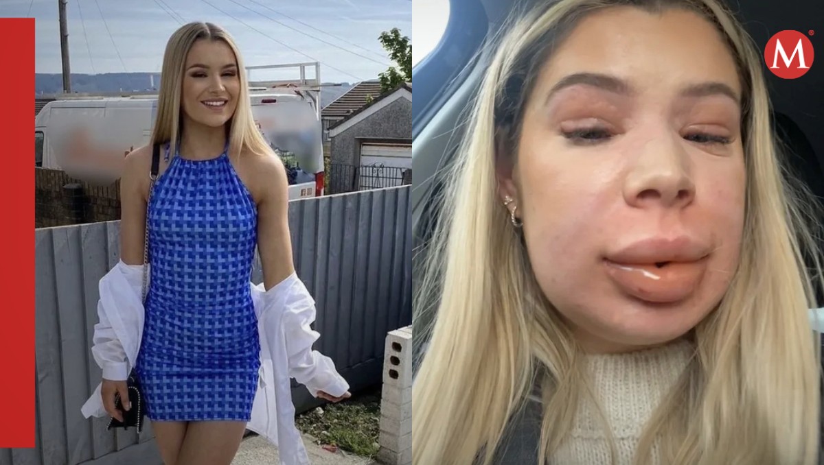Joven usa relleno de labios y tiene una reacción alérgica mortal: FOTO