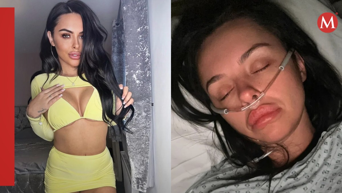 Modelo de OnlyFans casi muere tras inyectarse relleno en los glúteos