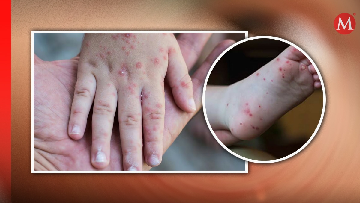 Conoce los síntomas y cómo se contagia el virus coxsackie.