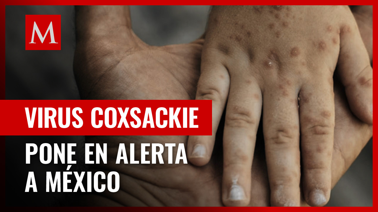 Qué es el coxsackie y cómo se contagia la enfermedad que tiene en alerta a México