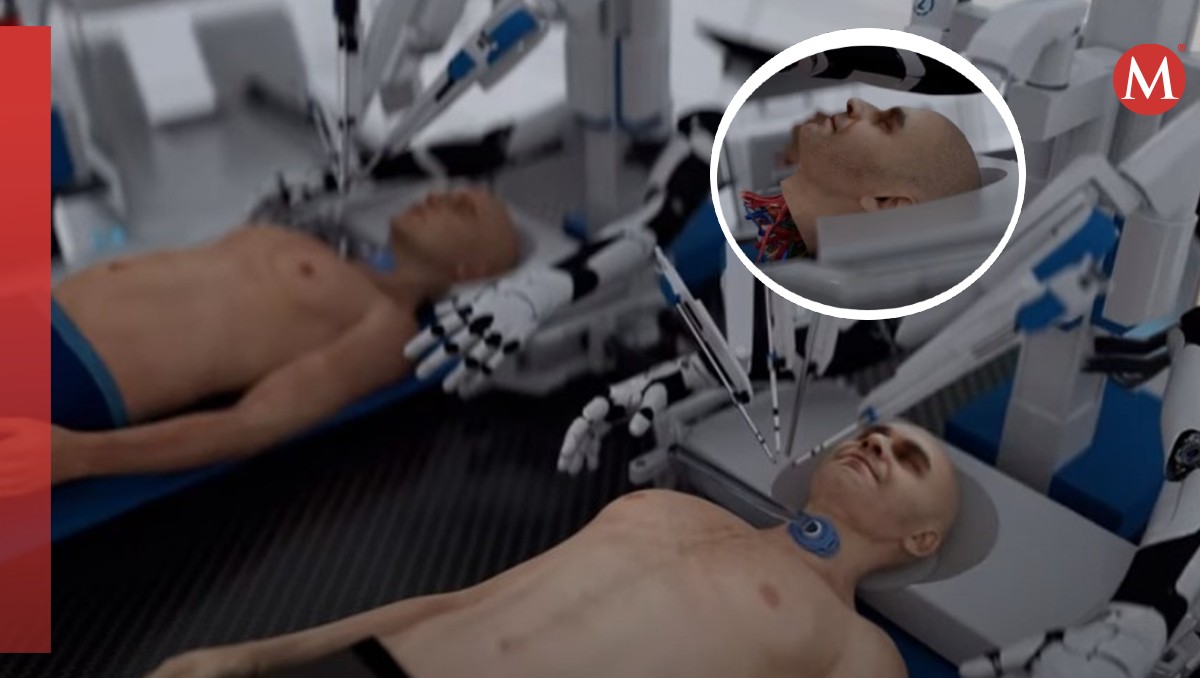 Buscan concretar trasplante de cabeza. | ESPECIAL