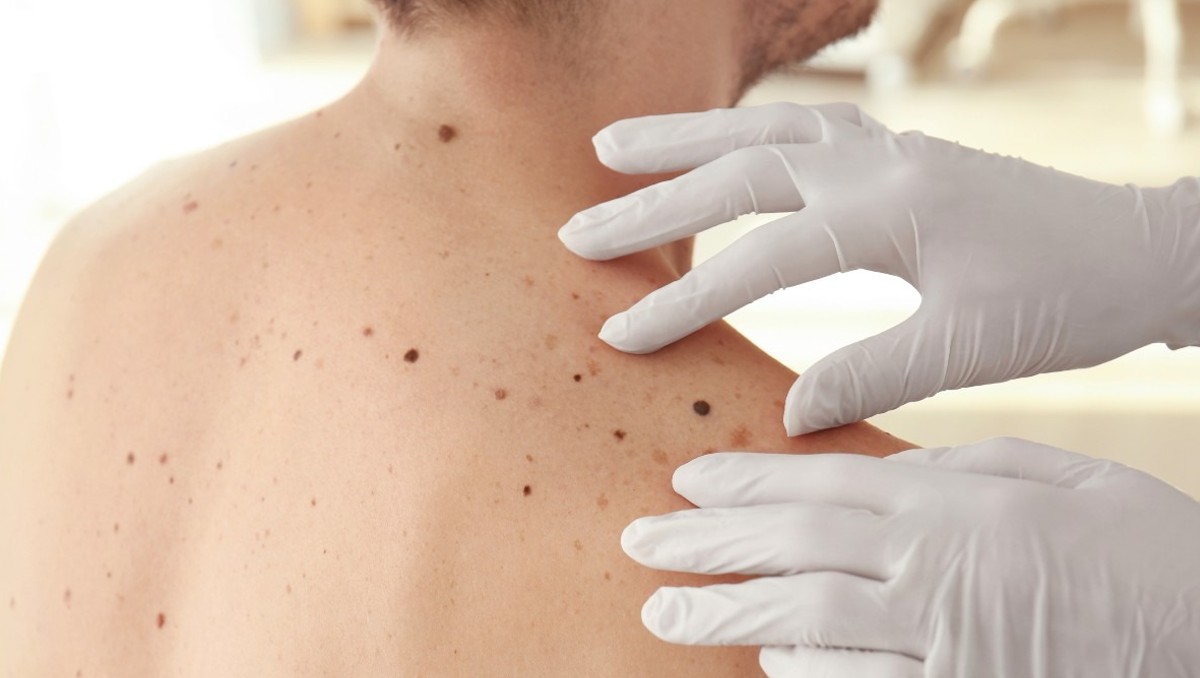 Personas pueden prevenir cáncer de piel con cuidados diarios para evitar sobre exposición al sol (Archivo)