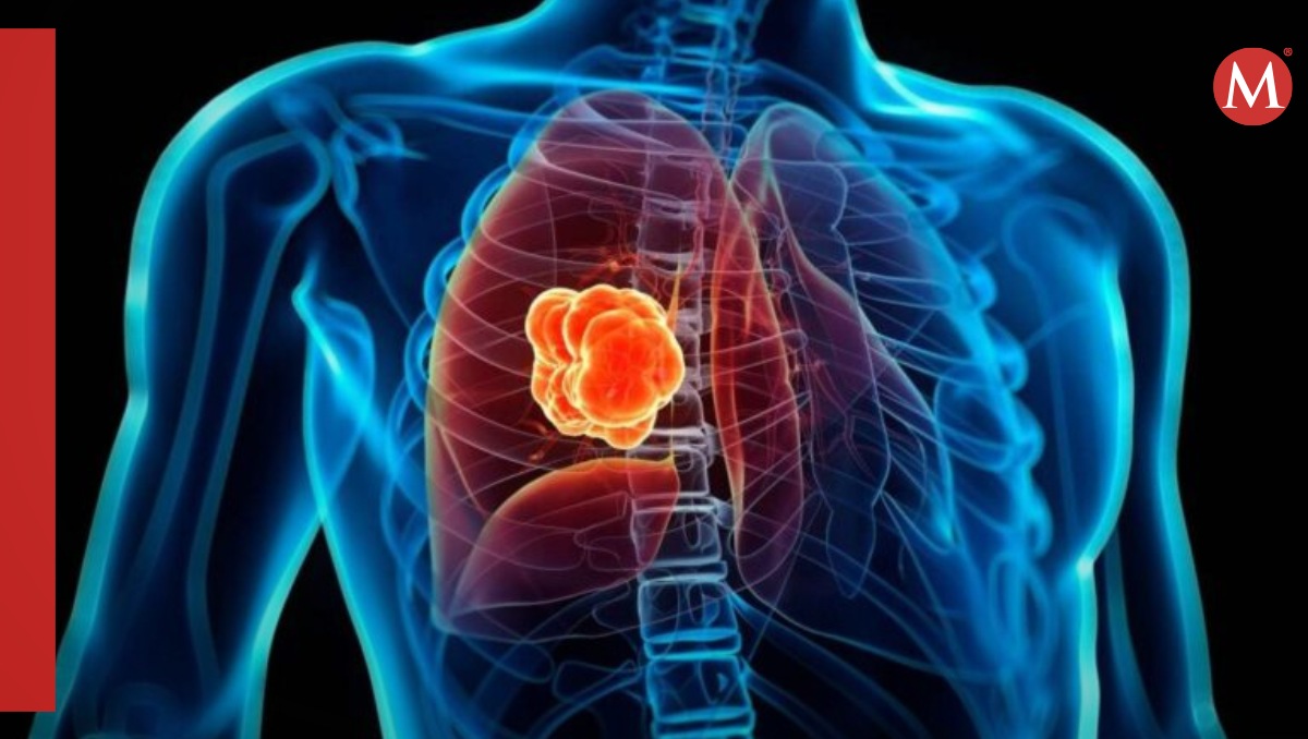 Fármaco contra tipo de cáncer de pulmón obtiene buenos resultados