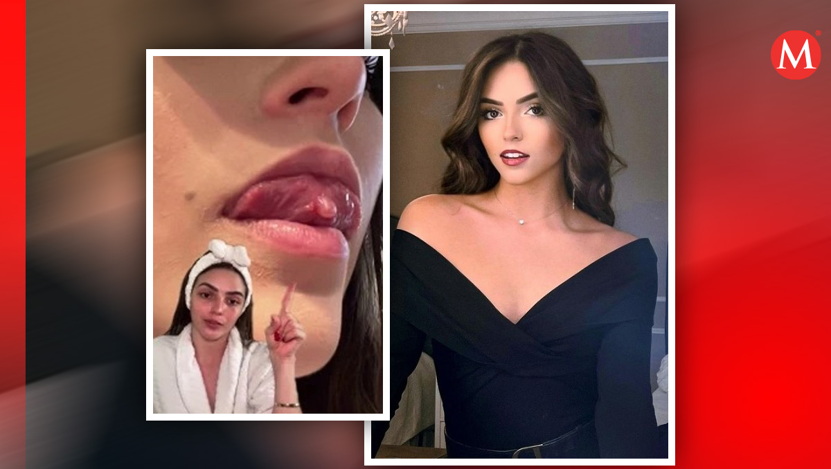 Alexa Castro ya había sido operada de un tumor en la lengua.