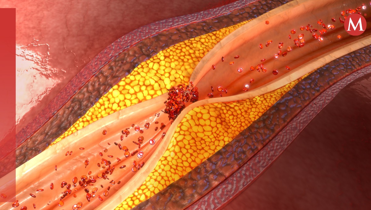 ¿Se puede revertir la enfermedad de las arterias coronarias?