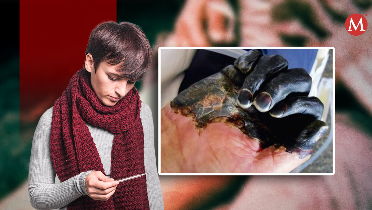 Estos son los síntomas de la peste bubónica