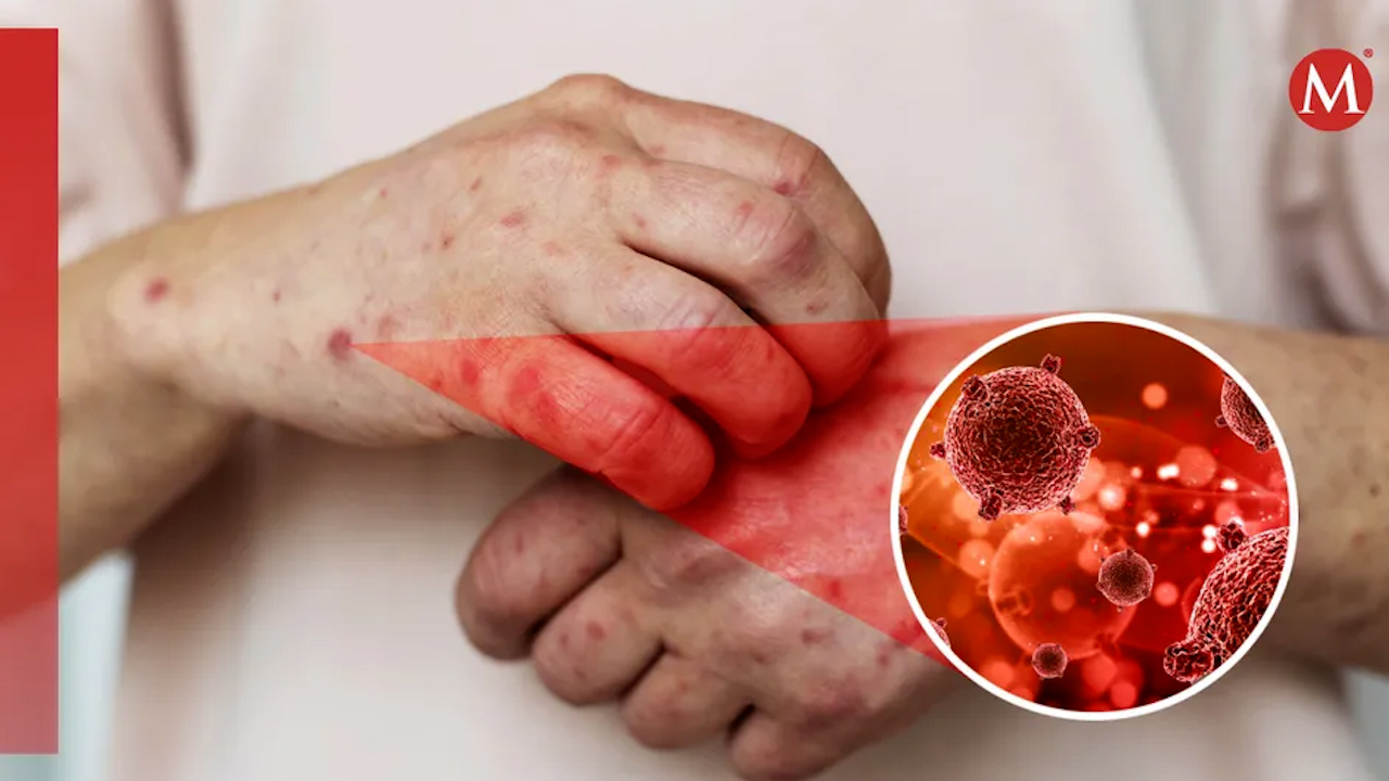 ¿Debemos preocuparnos por la emergencia sanitaria por viruela del mono?