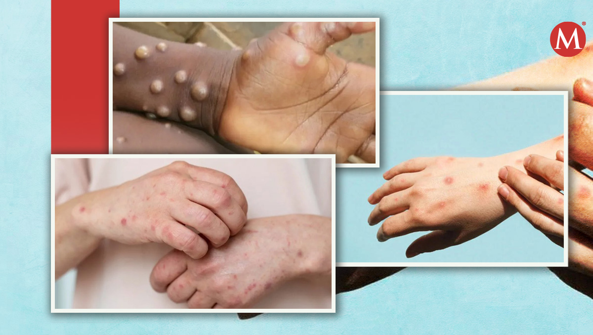 El Mpox o mejor conocida como 'viruela del mono' es una enfermedad causada por un virus.