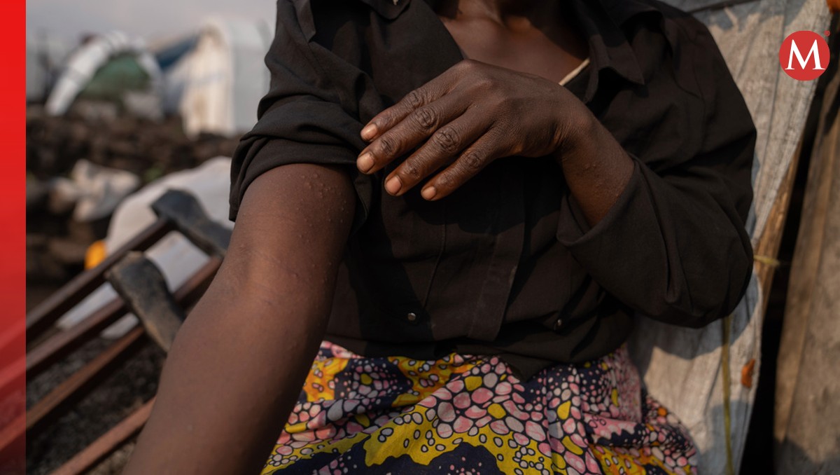 Mpox ya fue dos veces declarada emergencia sanitaria por la OMS. | AP