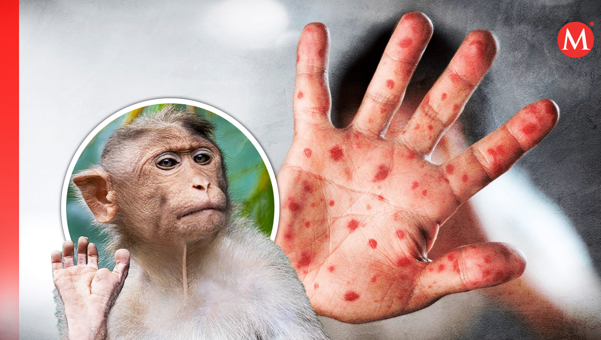 El virus Mpox fue conocido al principio como viruela del mono. | Especial