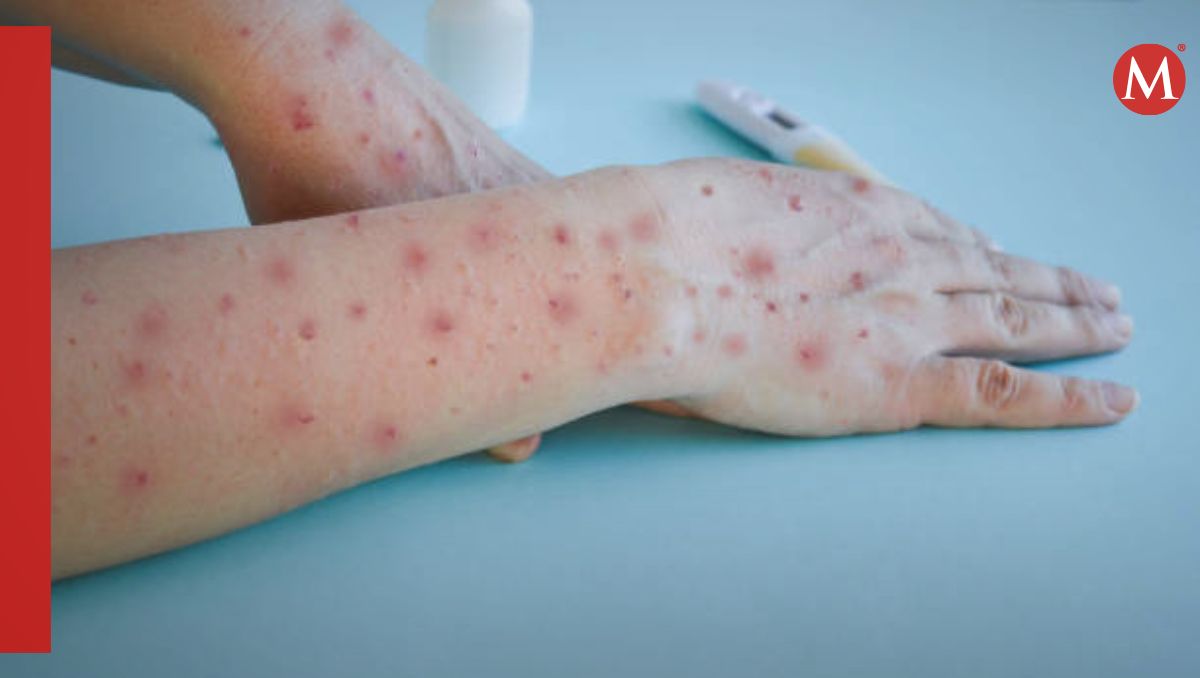 Hasta ahora no se han detectado casos de la nueva cepa de mpox en México| Foto: Especial