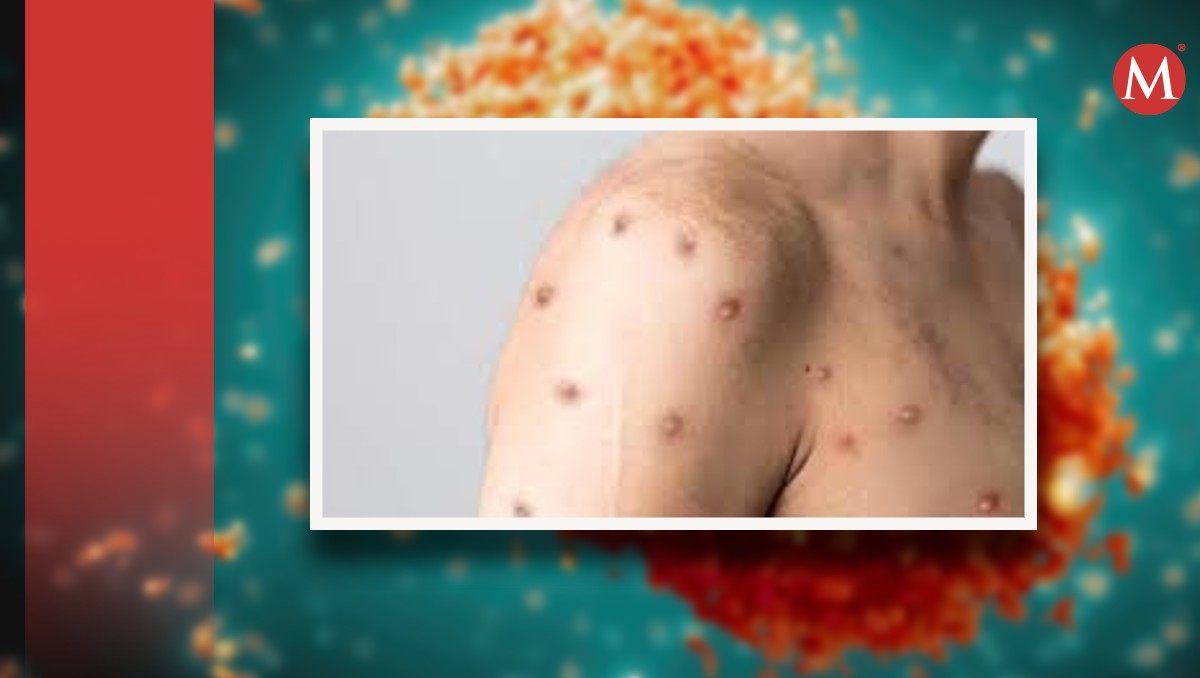 Casos de Mpox en Guanajuato