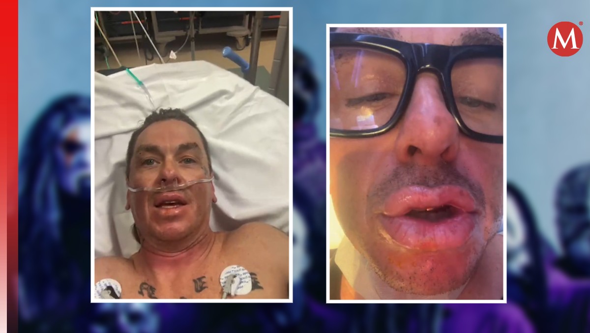 Sid Wilson, de Slipknot sufre explosión en la cara y le deja fuertes quemaduras.
