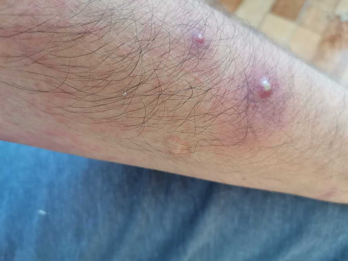 Paciente de mpox. (Foto: compartida por el entrevistado)