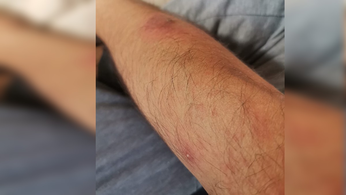 Marcas de mpox después de 20 días del contagio. (Foto: compartida por el entrevistado)