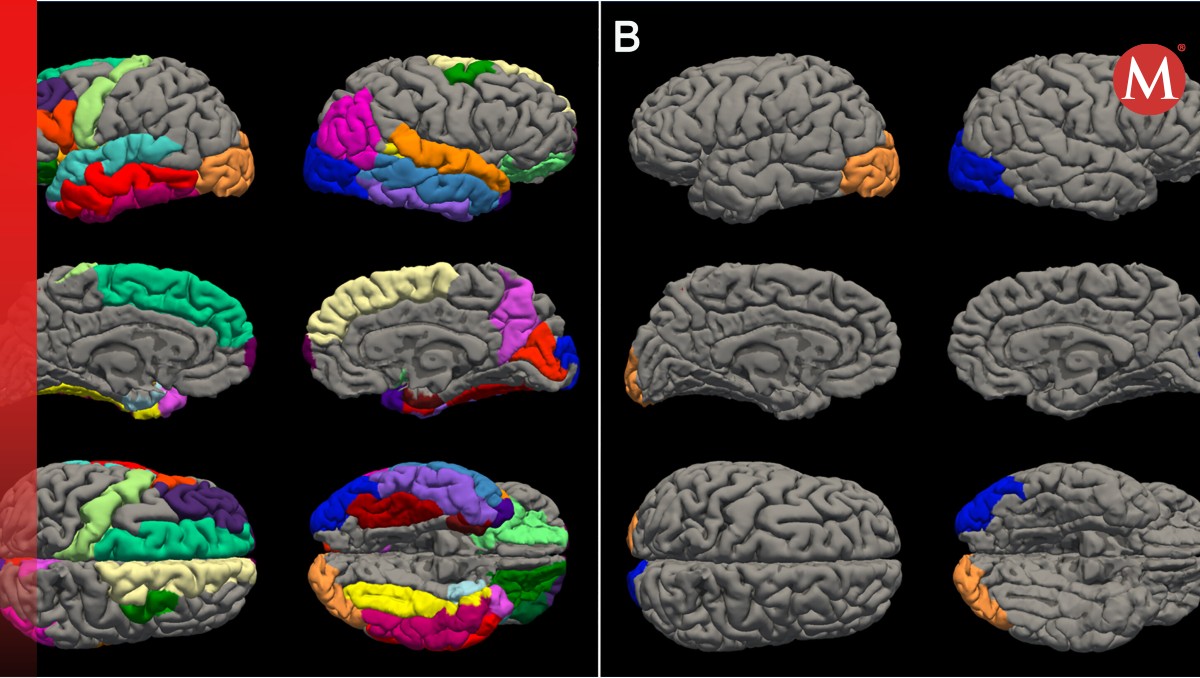 Las regiones con adelgazamiento cortical acelerado en el cerebro adolescente post-COVID-19: A) masculino B) femenino | PNAS