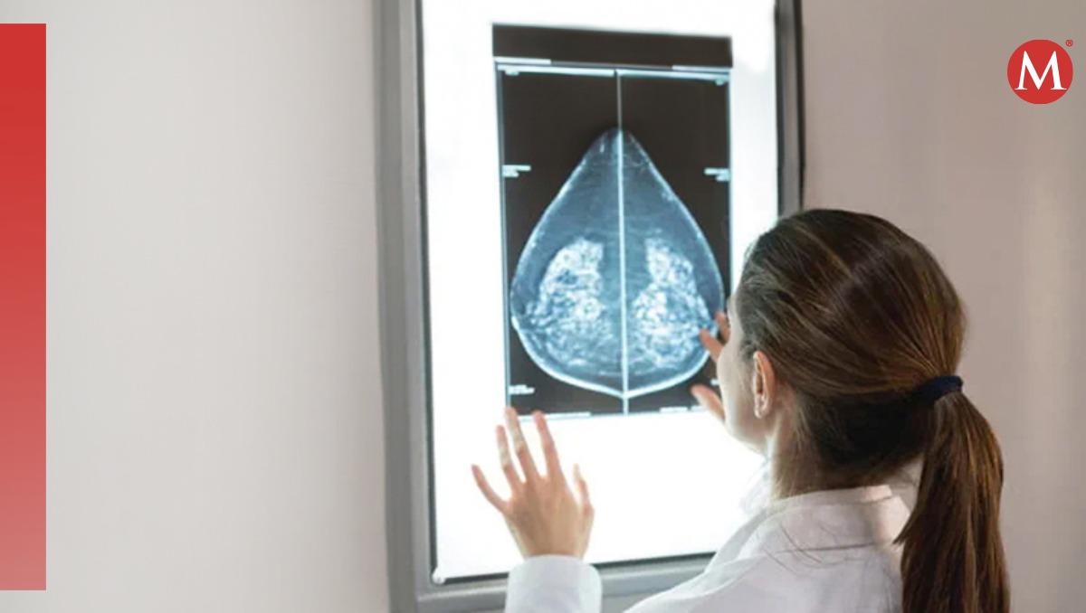 Guía para comprender las etapas del cáncer de mama
