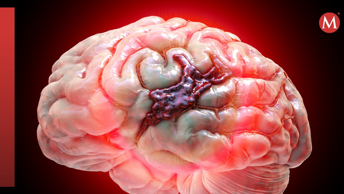 Nuevos modelos traslacionales para estudiar la hemorragia cerebral