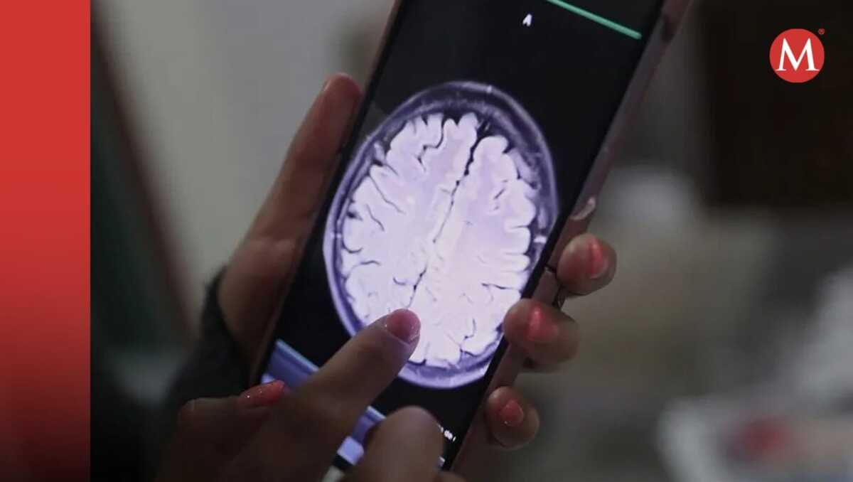 Imagen de un tumor alojado en en cerebro