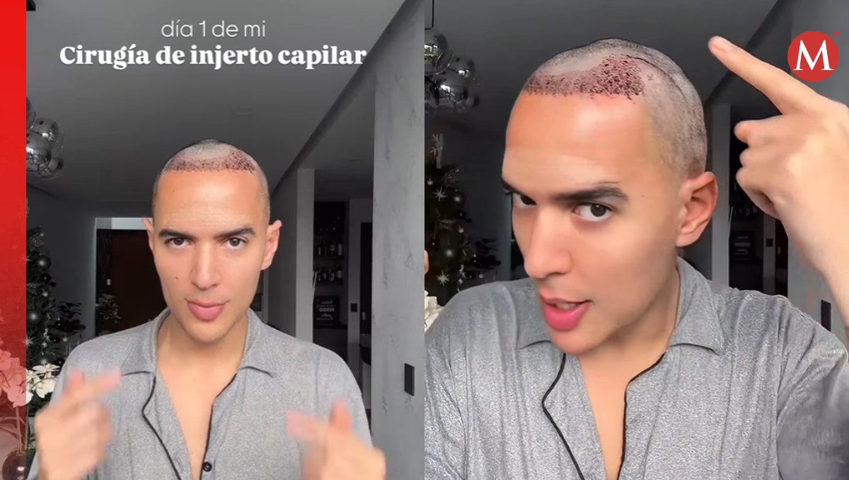 Un Tal Fredo se somete a cirugía de injerto capilar y graba el proceso