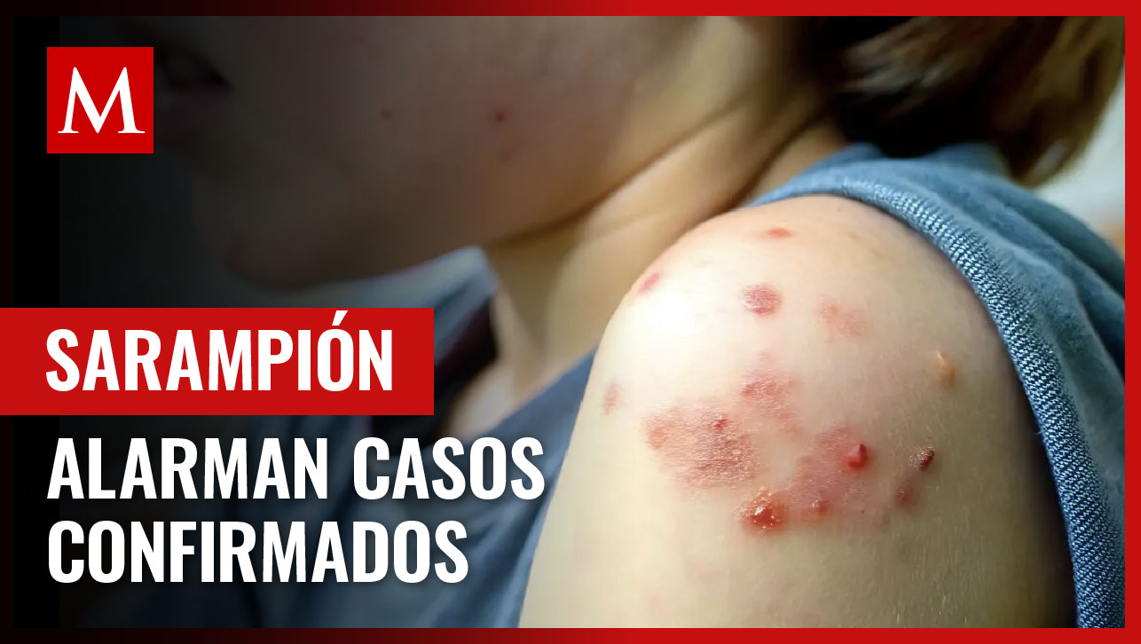 Brote de sarampión: ¿En qué estados de México hay casos?- Grupo Milenio Brote de sarampión: ¿En qué estados de México hay casos?- Grupo Milenio