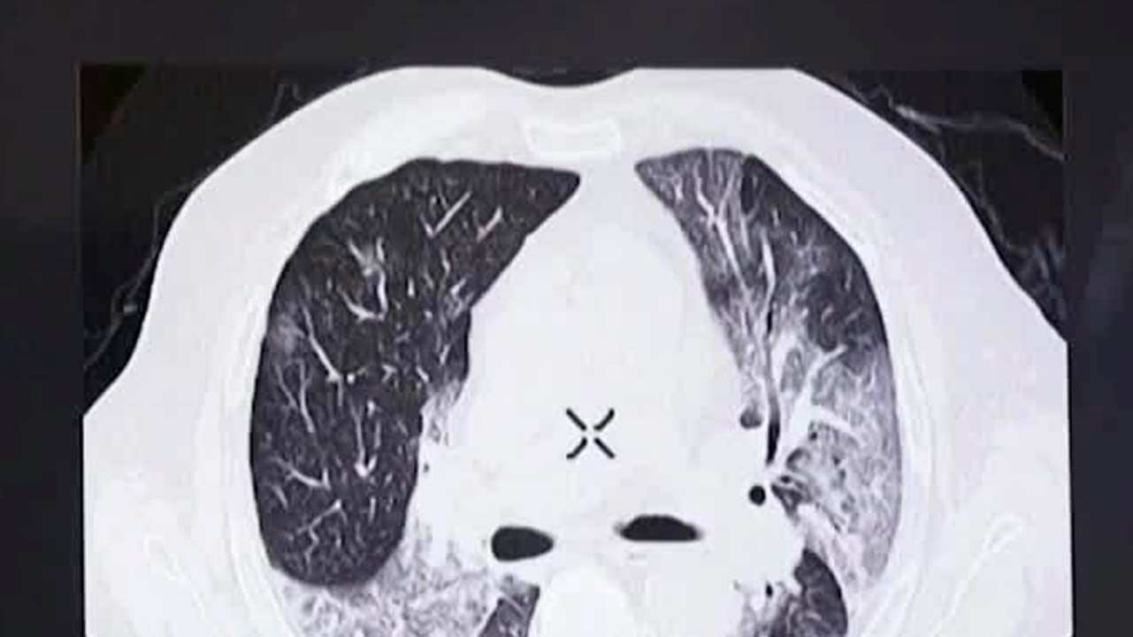 México avanza en herramientas para prevenir el VPH