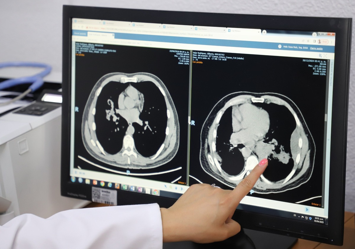 El cáncer de pulmón causa la muerte de 22 personas a diario, es decir, más de 8 mil mexicanos anualmente. | Foto: Javier Ríos