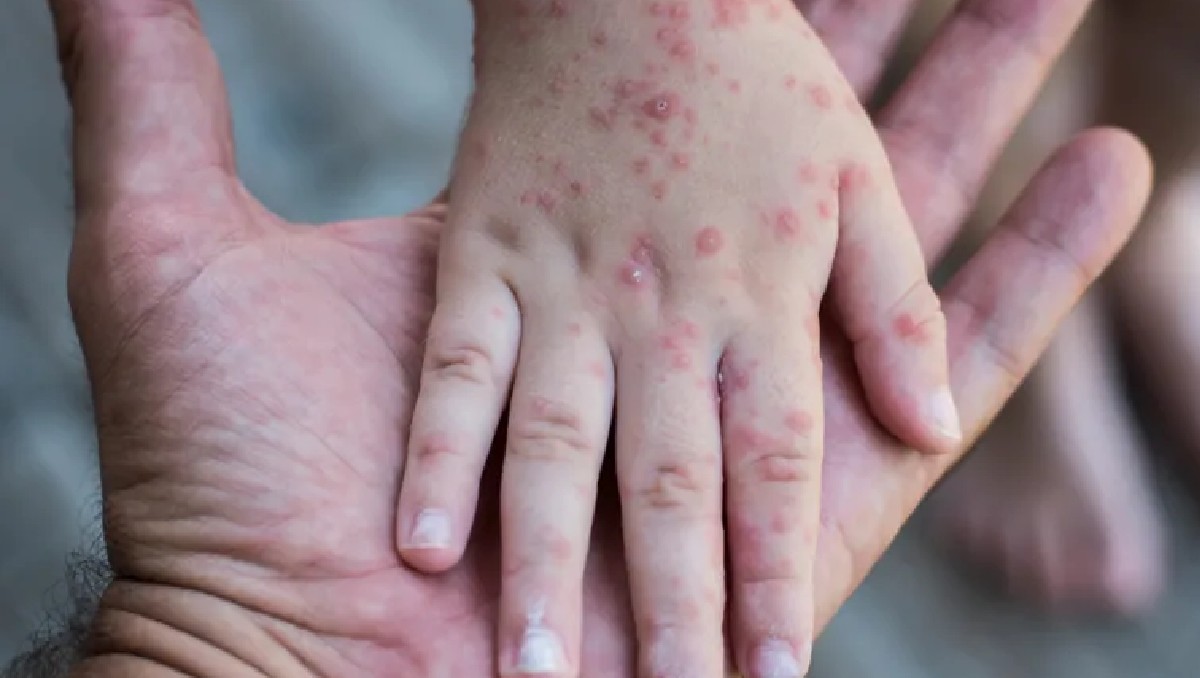 El sarampión es altamente contagioso entre los primeros siete a 10 días,  es decir, cuando todavía no se manifiestan  síntomas.