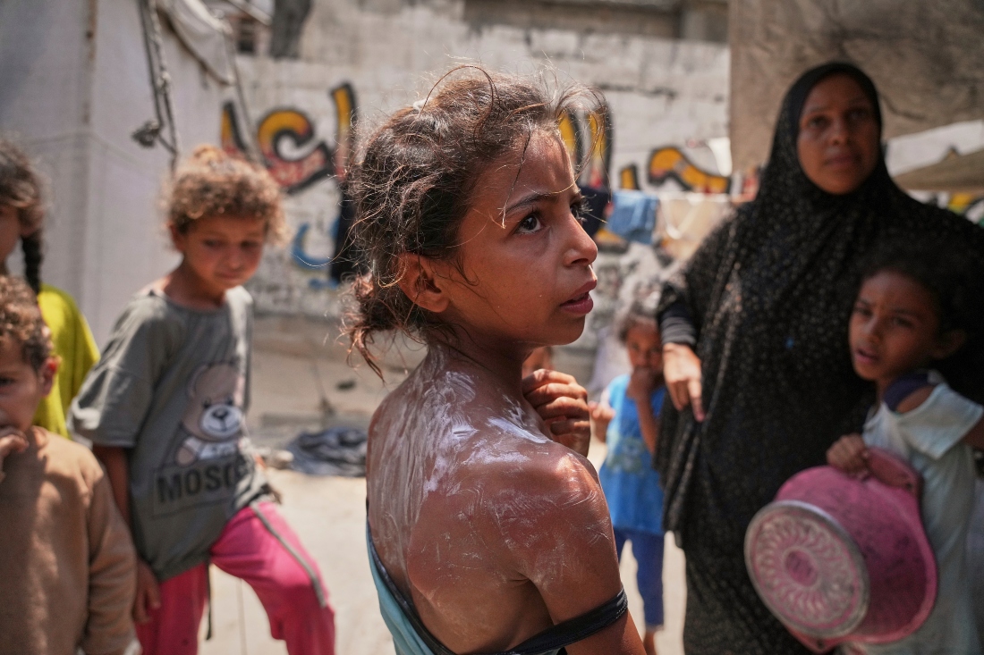 Una niña de 9 años permanece de pie después de recibir crema para aliviar las quemaduras en espalda y hombro tras intentar conseguir comida. |AP