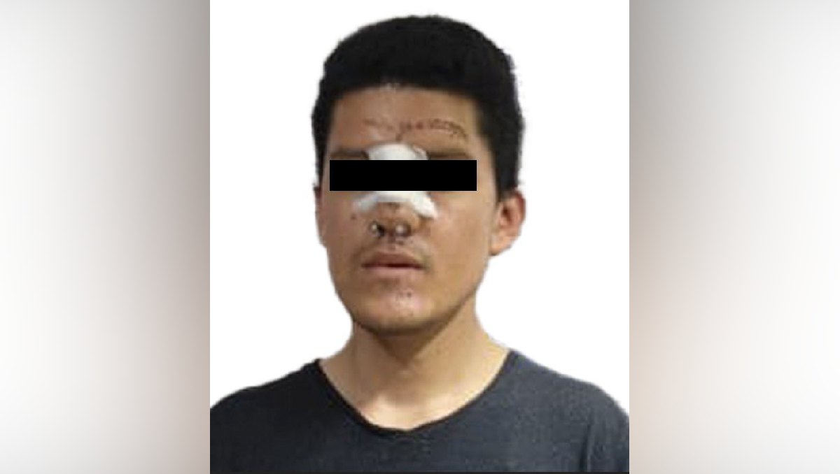 El detenido le provocó quemaduras en la región mandibular, cuello, tórax y brazo derecho de la víctima. Foto: (Especial)