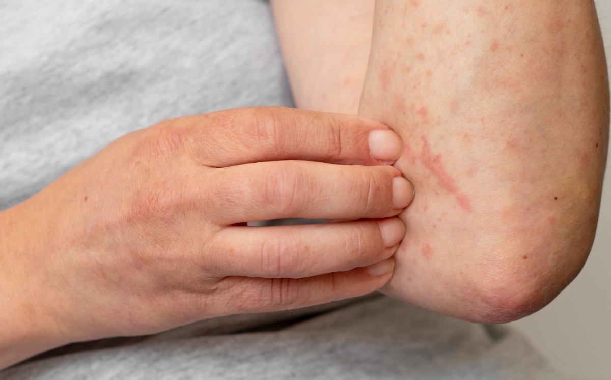 Distintos alérgenos pueden provocar inflamación en diferentes zonas del cuerpo. | Especial