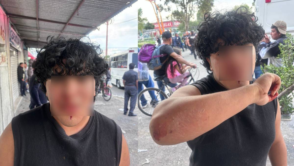 Daniel, un joven de 16 años, presenta múltiples golpes tras haber sido agredido por elementos de la Policía de Ecatepec.| Especial