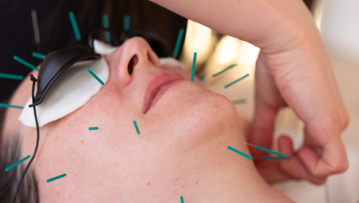 Acupuntura. (Foto: The New York Times)