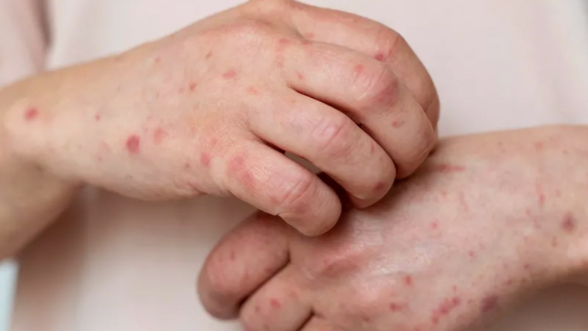 Oaxaca refuerza filtros sanitarios por aumento en contagios de Sarampión; vendrían de EU