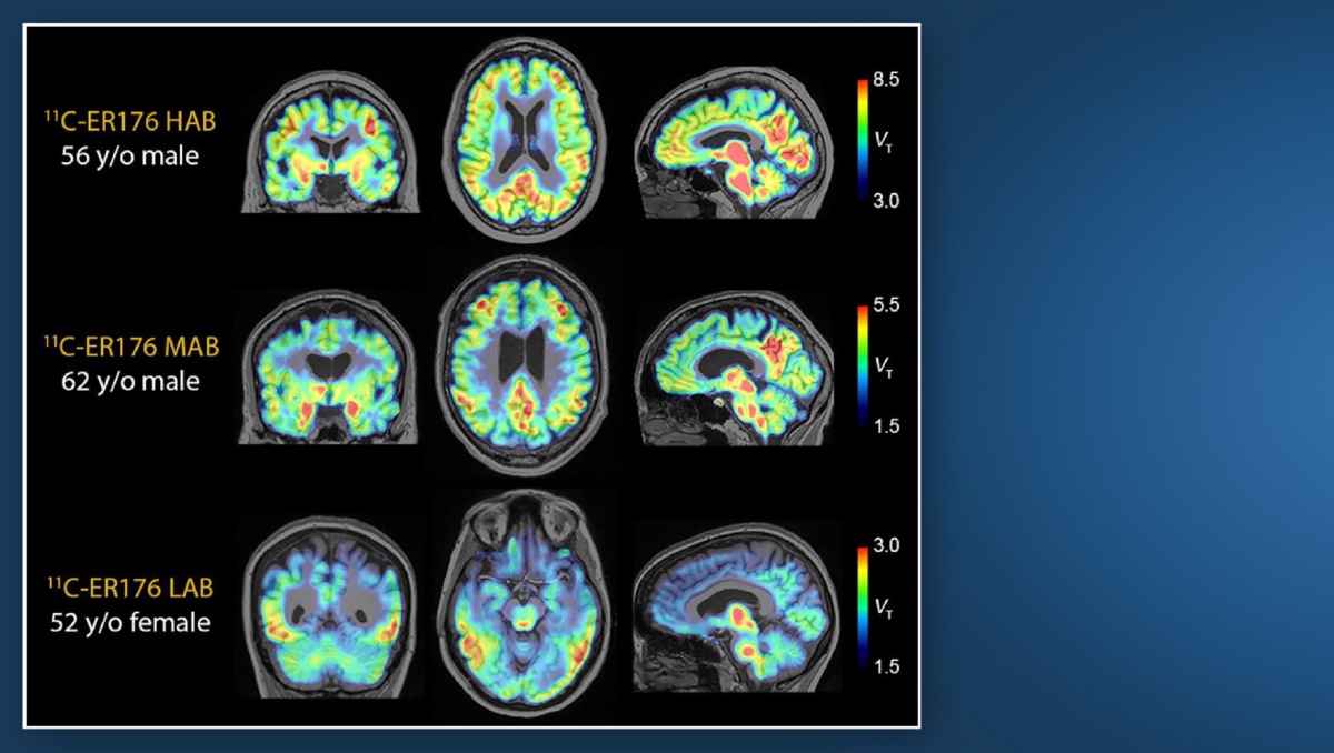Alzheimer: Nuevo trazadores de inflamación clave en el desarrollo