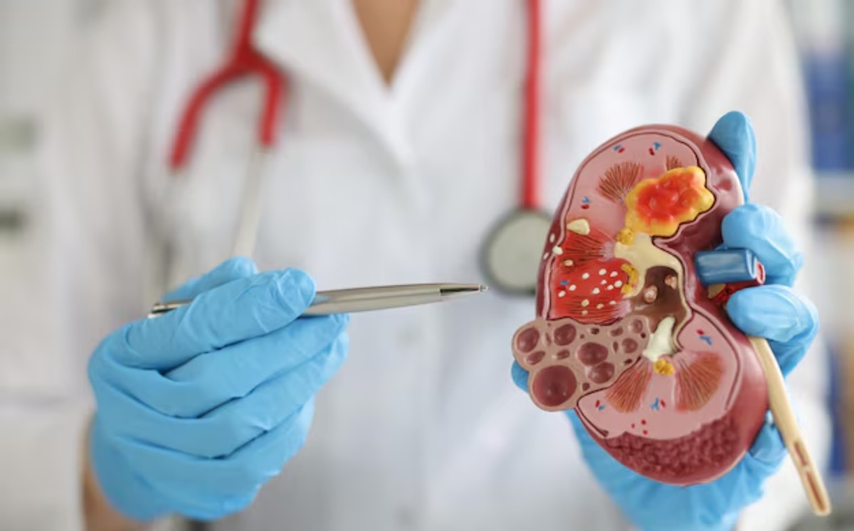 La Enfermedad Renal Poliquística (PKD) sigue siendo un misterio para muchas personas, aunque afecta a miles en México. | Freepik