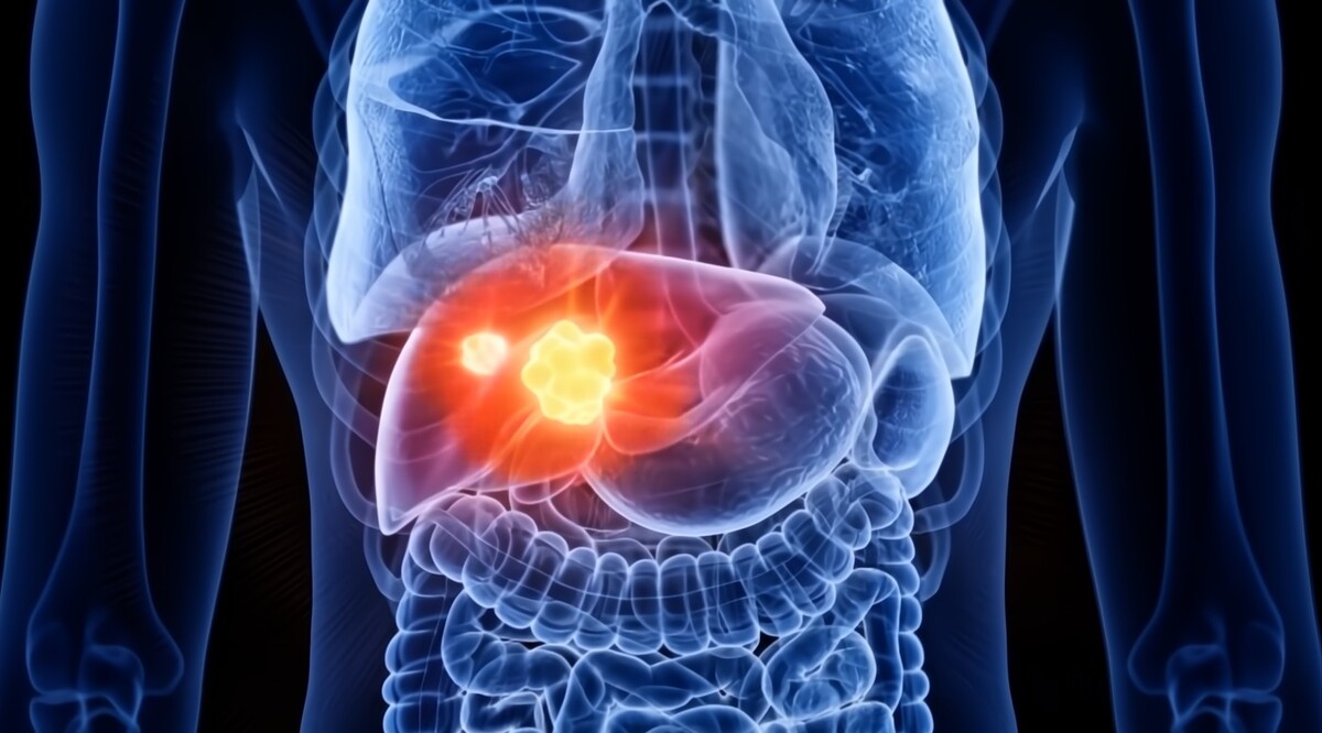 Cada año se detectan alrededor de seis mil nuevos casos de cáncer de hígado en México. | Especial